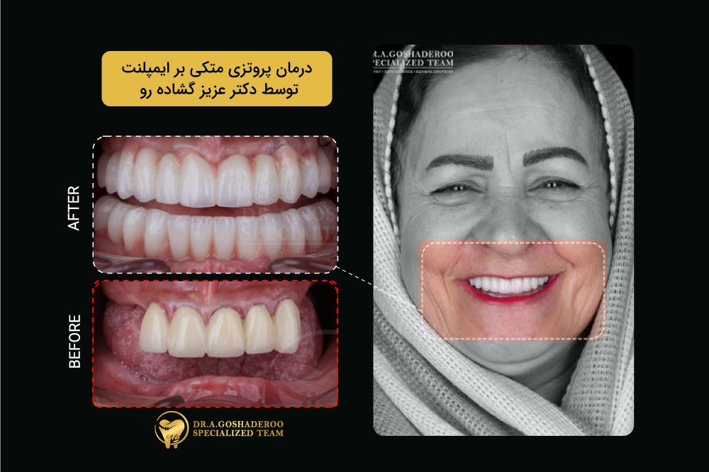 آیا ایمپلنت دندان درد دارد؟